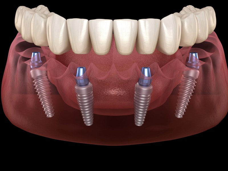 All-On-X Full Arch