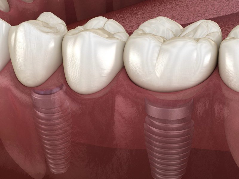 Implant Bridge