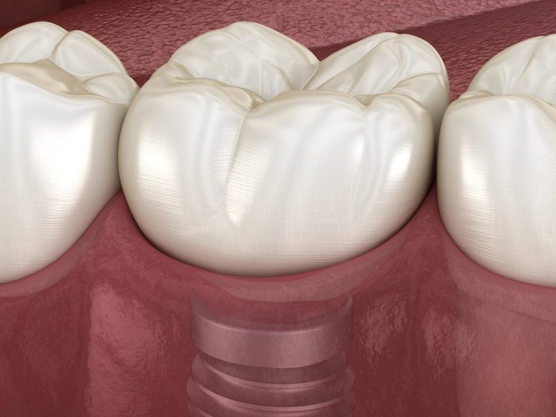 Single Tooth Implant